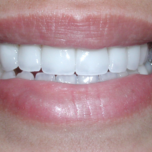 Veneers