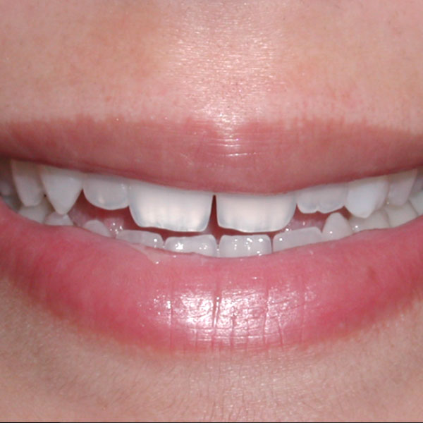Veneers