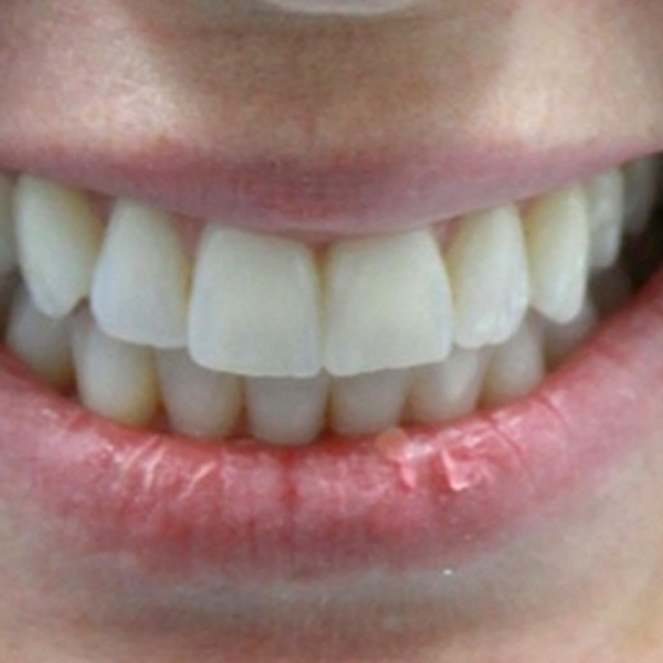 Invisalign