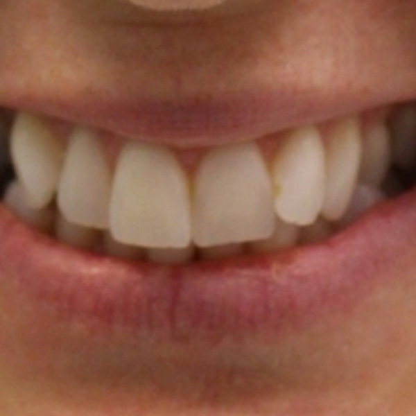 Invisalign