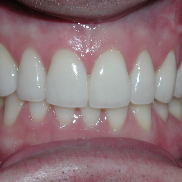 Veneers